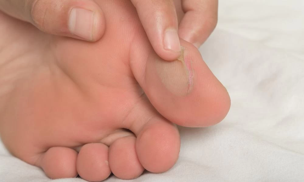 Φουσκάλες από τα παπούτσια: Αυτός είναι ο καλύτερος τρόπος πρόληψης